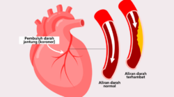 Undangan Penyuluhan Kesehatan Jantung: Meningkatkan Kesadaran untuk Kesehatan Jantung yang Lebih Baik
